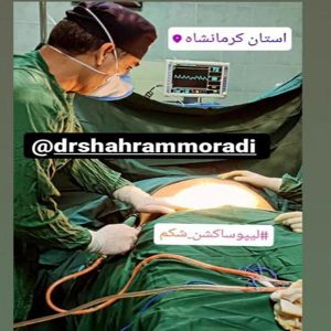 دستگاه ساکشن لاغری