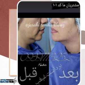 دستگاه ساکشن چربی